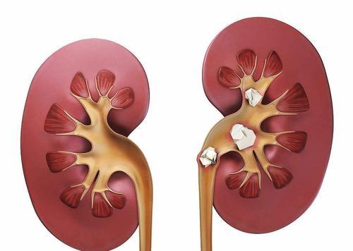 为什么你容易尿酸高肾结石可能与这种体质密切相关