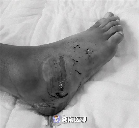 17岁男孩江边被毒蛇咬伤夏季谨防蛇出没防蛇自救学起来