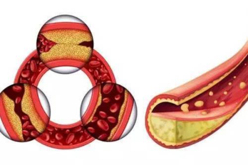 怎么降低胆固醇减少心脑血管病?研究发现这种