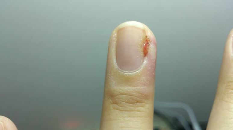 真不是吓唬你!撕"倒戗刺"可能会导致截指,你信吗?