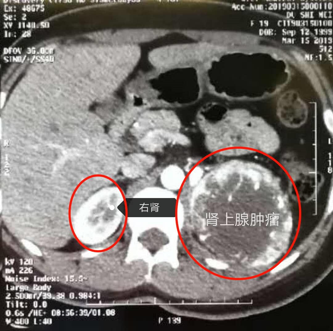 哈医大二院泌尿外科专家腹腔镜手术切除11公分恶性嗜铬细胞瘤|肾上腺