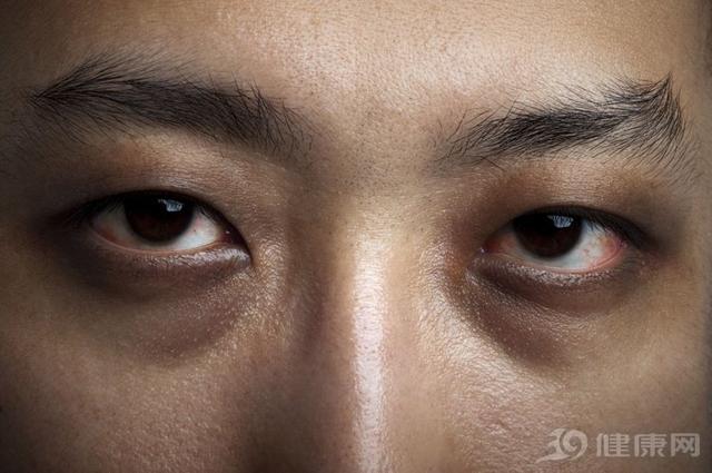 且没有光泽的,而且还会有严重的黑眼圈,这些都是慢性肝病患者比较早期