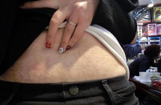 产后肚子像大西瓜看到要自闭预防妊娠纹做好3点是王道