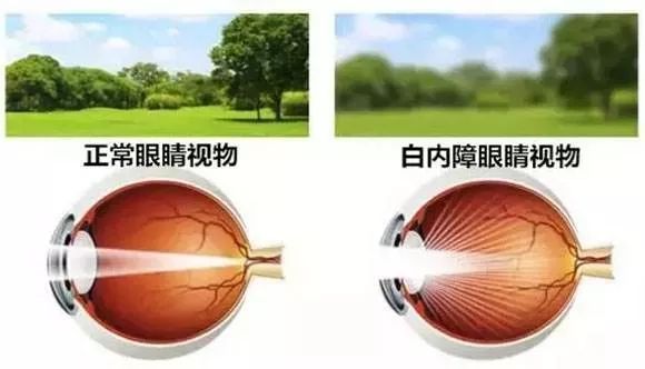 老花青光眼白内障常见老年眼病及认识误区