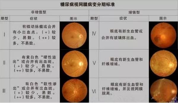 常见老年眼病及认识误区|眼病|青光眼|视网膜_新浪新闻