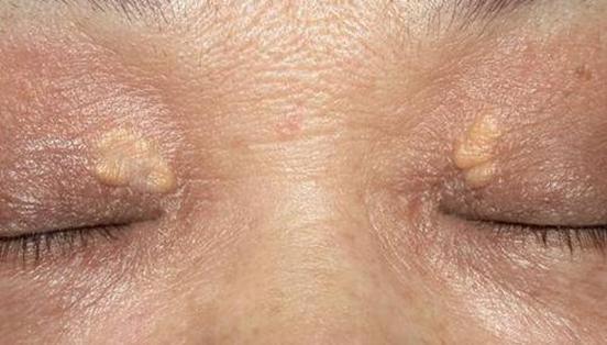 眼睑上长了黄色斑块究竟是一种怎样的疾病?该如何治疗?