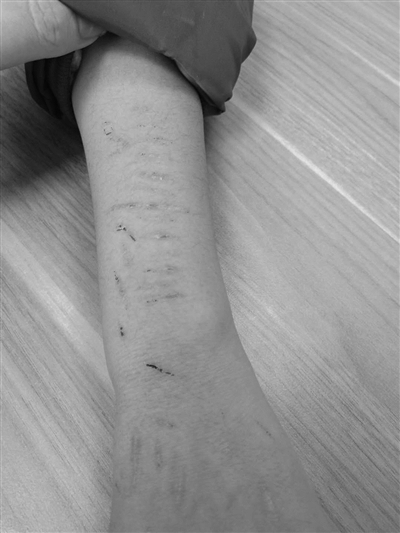 14岁女生将自己划得伤痕累累