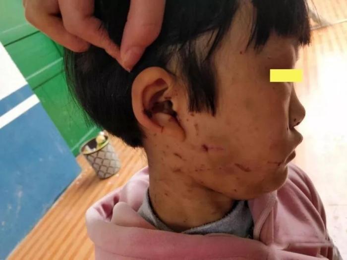 9岁女童遭奶奶暴打浑身是伤 儿子恼羞成怒将老母亲打了一顿|小女孩