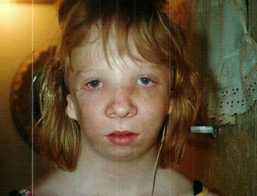 加利福尼亚州32岁的cynthiamurphy出生时患有罕见的崔契尔柯林斯症候