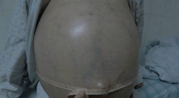 准妈妈羊水早破,立刻开刀,医生剖到第3个时,却