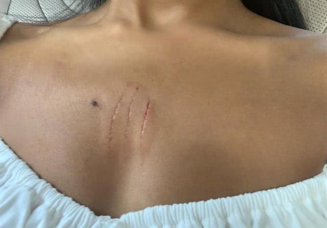 吉克隽逸被爱猫抓伤前胸三道伤疤很明显连打8针在病床上哭泣