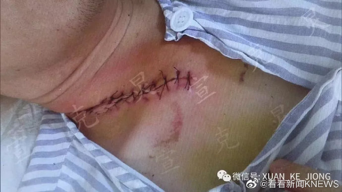 上海一快递员持刀砍伤客户脖子就因为被投诉偷懒放快递