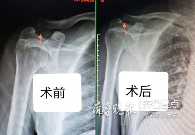 肩锁关节脱位不需戴钢板这个微创手术只留几个小眼