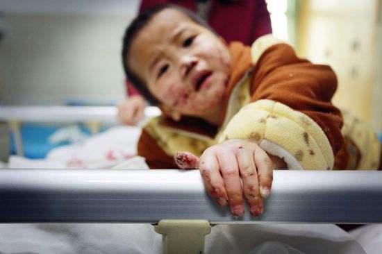 老鼠竟然能吃人尼日利亚一个小姑娘被老鼠吃掉耳朵鼻子丧生