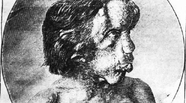 头围91厘米的传奇"象人":坐着睡觉跳着赚钱,躺下就会窒息死亡