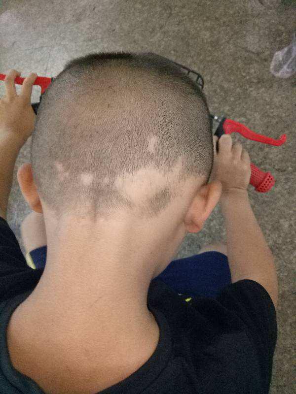 如何预防儿童斑秃?斑秃(四)