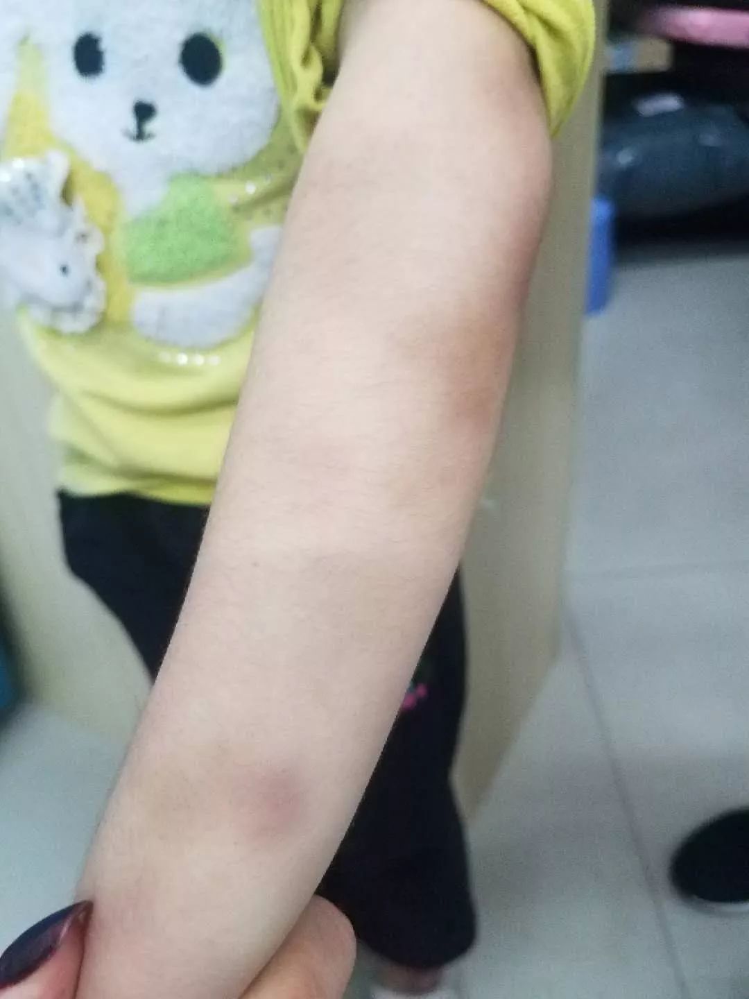 广东河源七岁女童疑遭母亲家暴入院警方介入