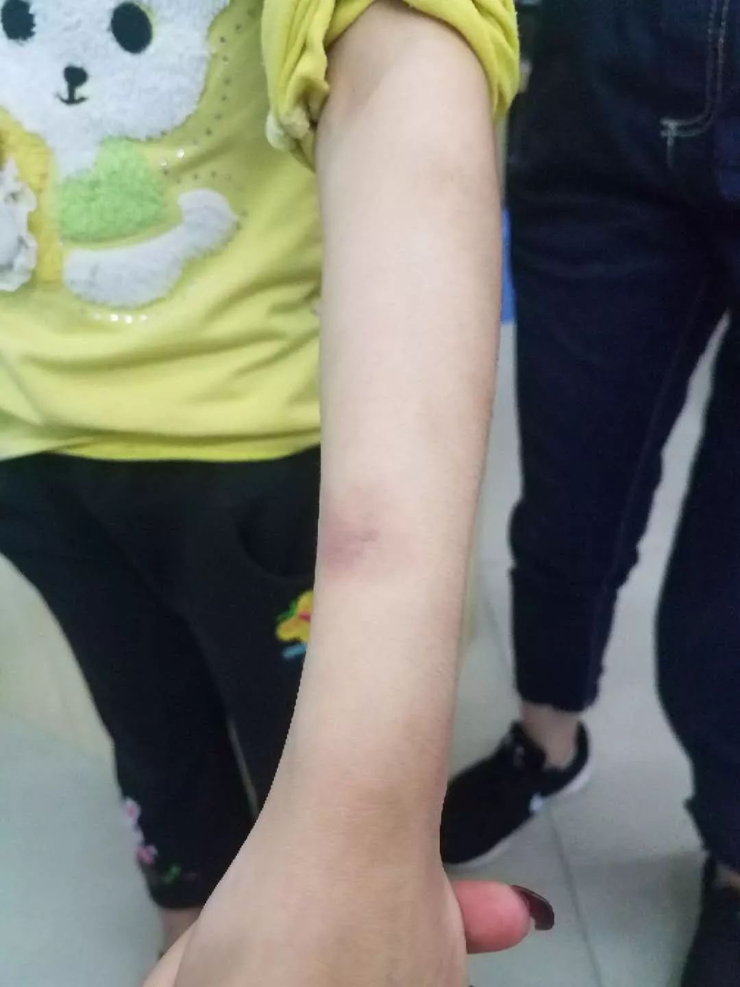 广东河源七岁女童疑遭母亲家暴入院警方介入