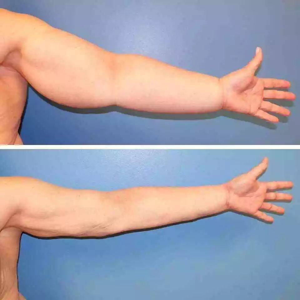 76斤的鞠婧祎手臂粗得像110斤,丸型臂,水肿臂太可怕了!