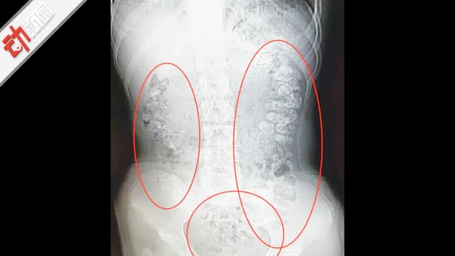 14岁女孩喝奶茶肚子疼5天 胃内现百余颗"珍珠"