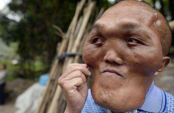 男子怪病似恐怖外星人,已长到两个头这么大