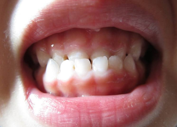 宝宝地包天,除了父母遗传,还可能是生活中这4个坏习惯引起的插图3