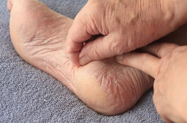 血糖高"脚先知"!提醒:脚部出现3种"异常",说明血糖过高了