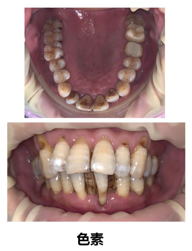 注意牙齿上的小黑点竟然这么可怕千万别忽视