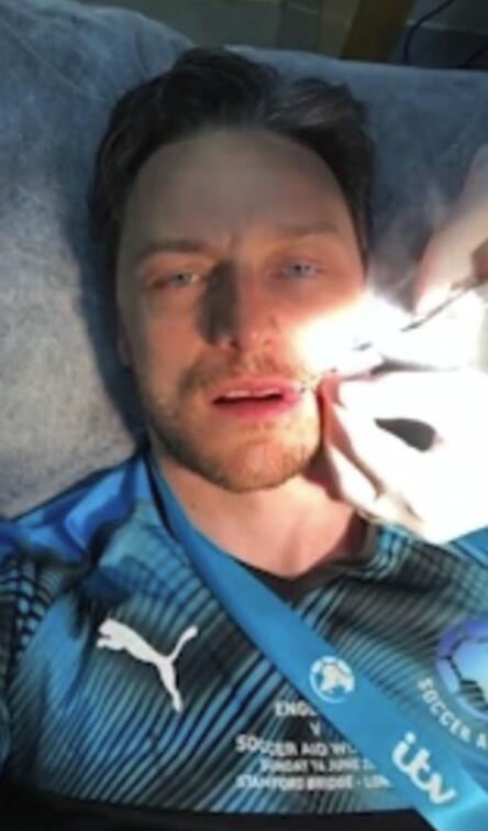 詹姆斯麦卡沃伊踢慈善球赛 被误伤嘴部缝针