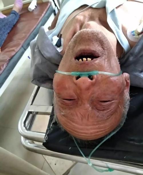 60岁老汉休克昏迷确诊胃癌晚期家属不信两年三次胃镜都没事