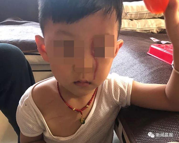 三岁男童电梯里遭大型犬抓出十厘米血印!监控令人揪心
