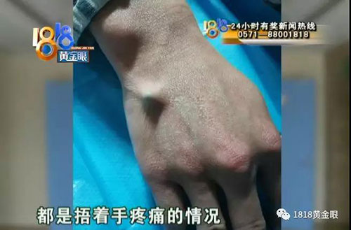 杭州发生多起筷子刺入手掌意外