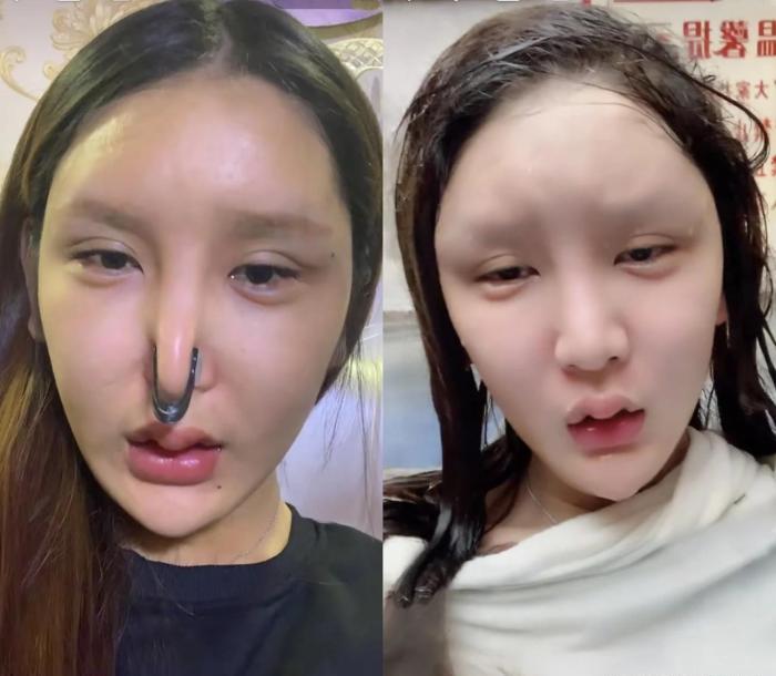 网红整容失败,86万打水漂,看见她素颜的样子才知道医生尽力了