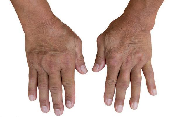 1分钟告诉您痛风石的真相如何才能预防痛疯专家给您答案