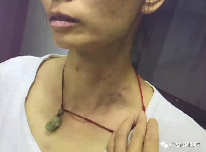 目前,王某已被警方依法刑事拘留,案件還在進(jìn)一步處理中。