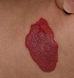 血管瘤会越来越红吗?出现这4点要必须去医院!