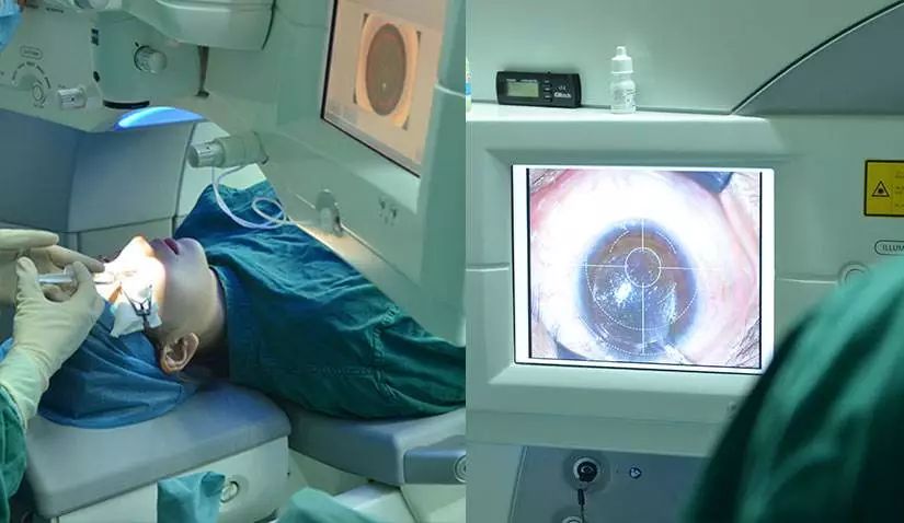 暑期又到高峰季 飞秒激光治近视需注意这些事|手术|眼药水_新浪新闻