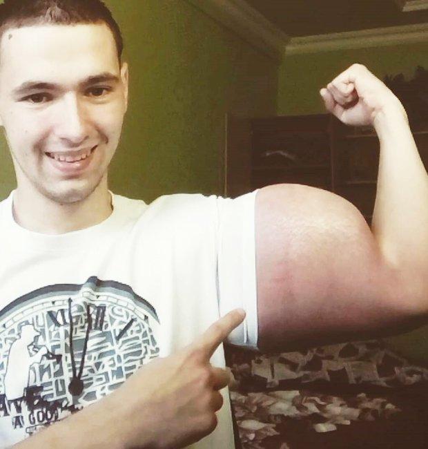 俄小伙胳膊注油粗过水桶成大力水手如今病菌感染恐被截肢