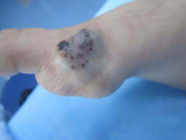 什么是静脉畸形血管瘤?2000宝妈前来咨询答案!