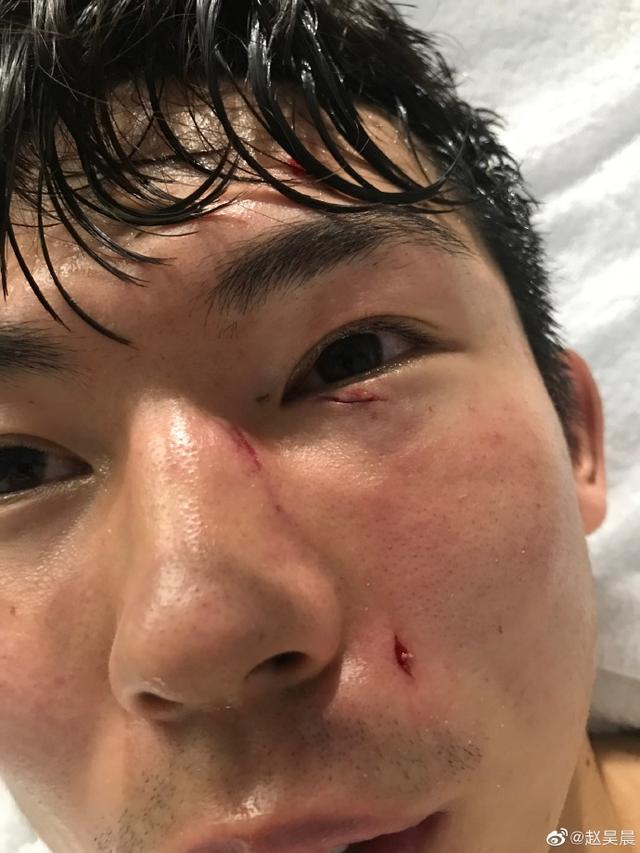 昊晨报平安,球员并无大碍,只是消毒太痛苦,而且从球员受伤的照片来看