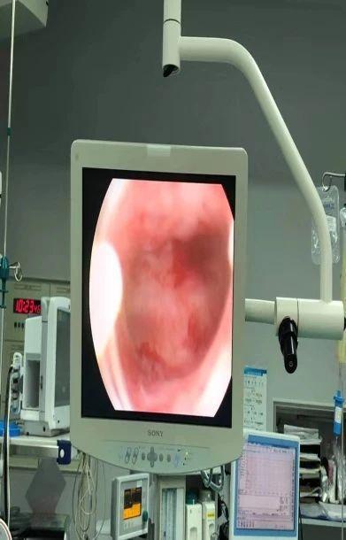 葡萄胎女子闭经两年难育 在中大附属第六医院系统治疗恢复例假