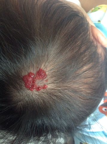 3万宝妈都在问毛细血管瘤可以不治吗专家解答