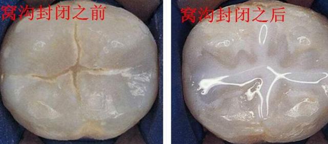 我9颗烂牙为防止孩子龋齿坚持3年绝不止刷牙加不吃糖那么简单