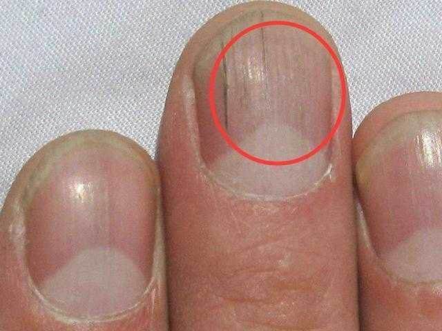 手指甲是粉色的光滑的,而如果肾脏出现了炎症或者肾虚之症,指甲就会长