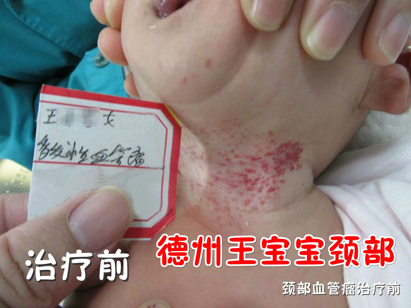 婴儿脖子有血管瘤能自己恢复吗?专家在线面对面解答