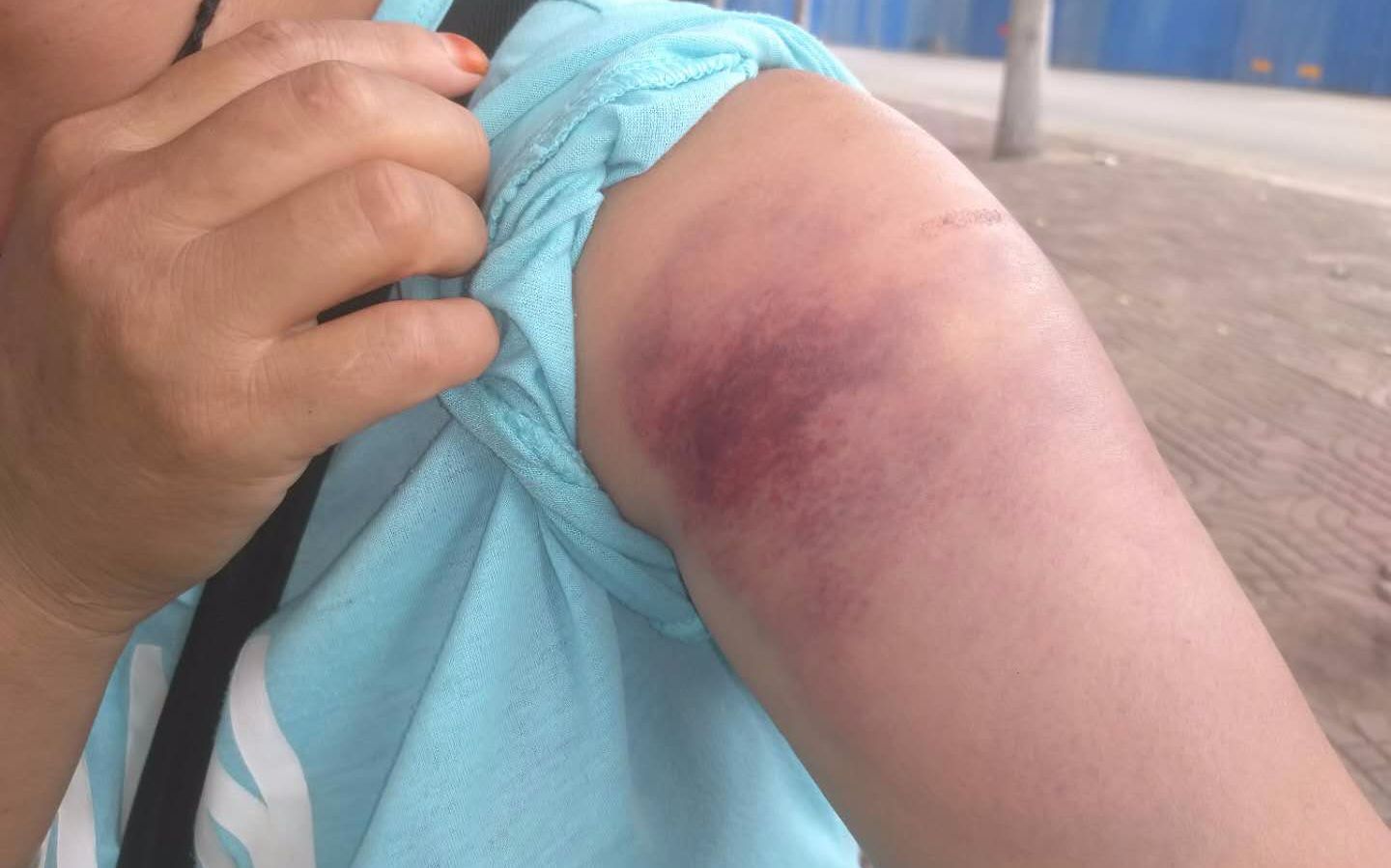 爆炸中,荣丽华的肩膀上留下一块淤青. 新京报记者 海阳 摄