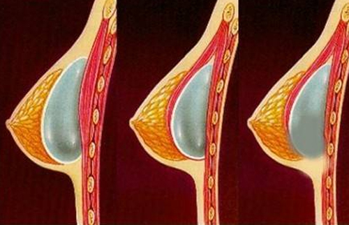 安全的方式现在可以规避包膜挛缩问题了吗
