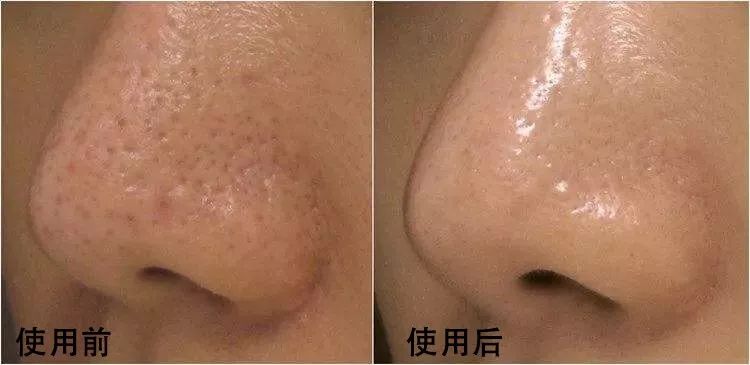 黑头粉刺不用挤,用它吸一下,自己乖乖跑出来,毛孔细腻,年轻十岁!