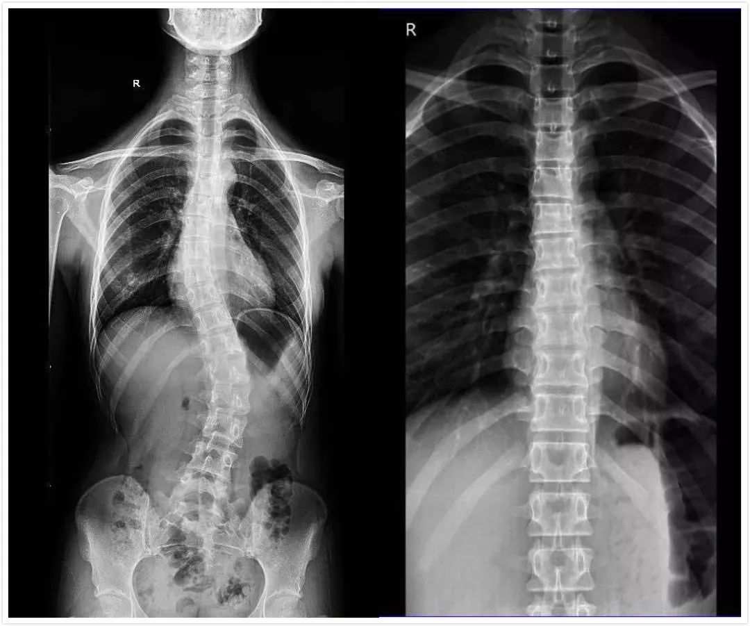 高低肩驼背歪脖子小心脊柱侧弯4个方法为孩子检查