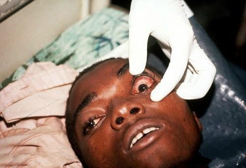 埃博拉病毒导致人体血管破裂不真正的原因是细胞因子风暴